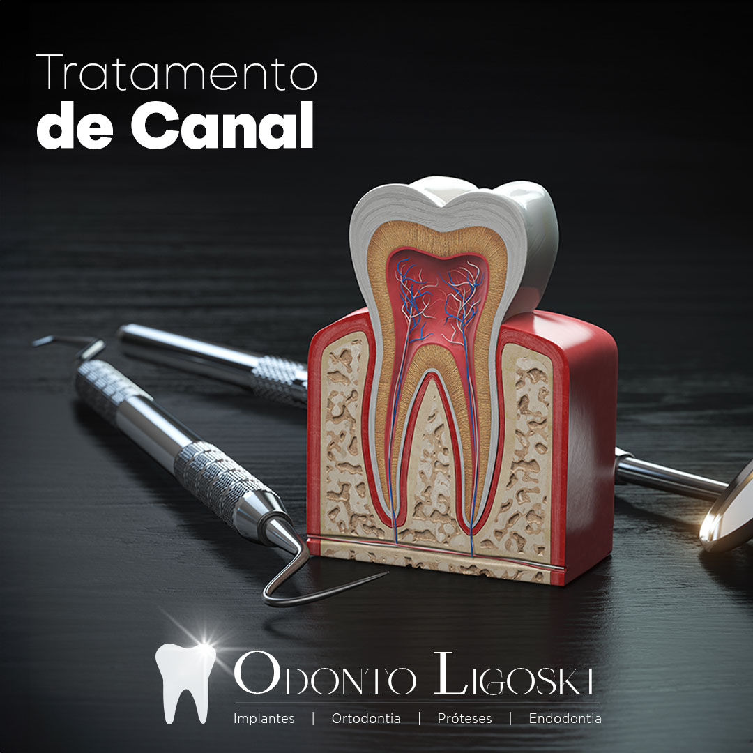 Tratamento de Canal