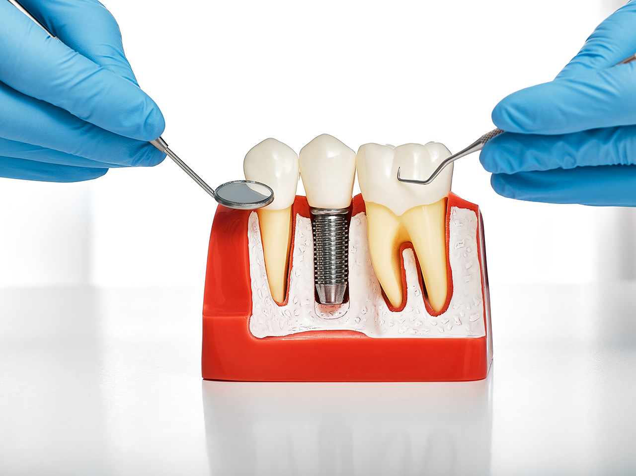 Mitos e verdades sobre implantes dentários